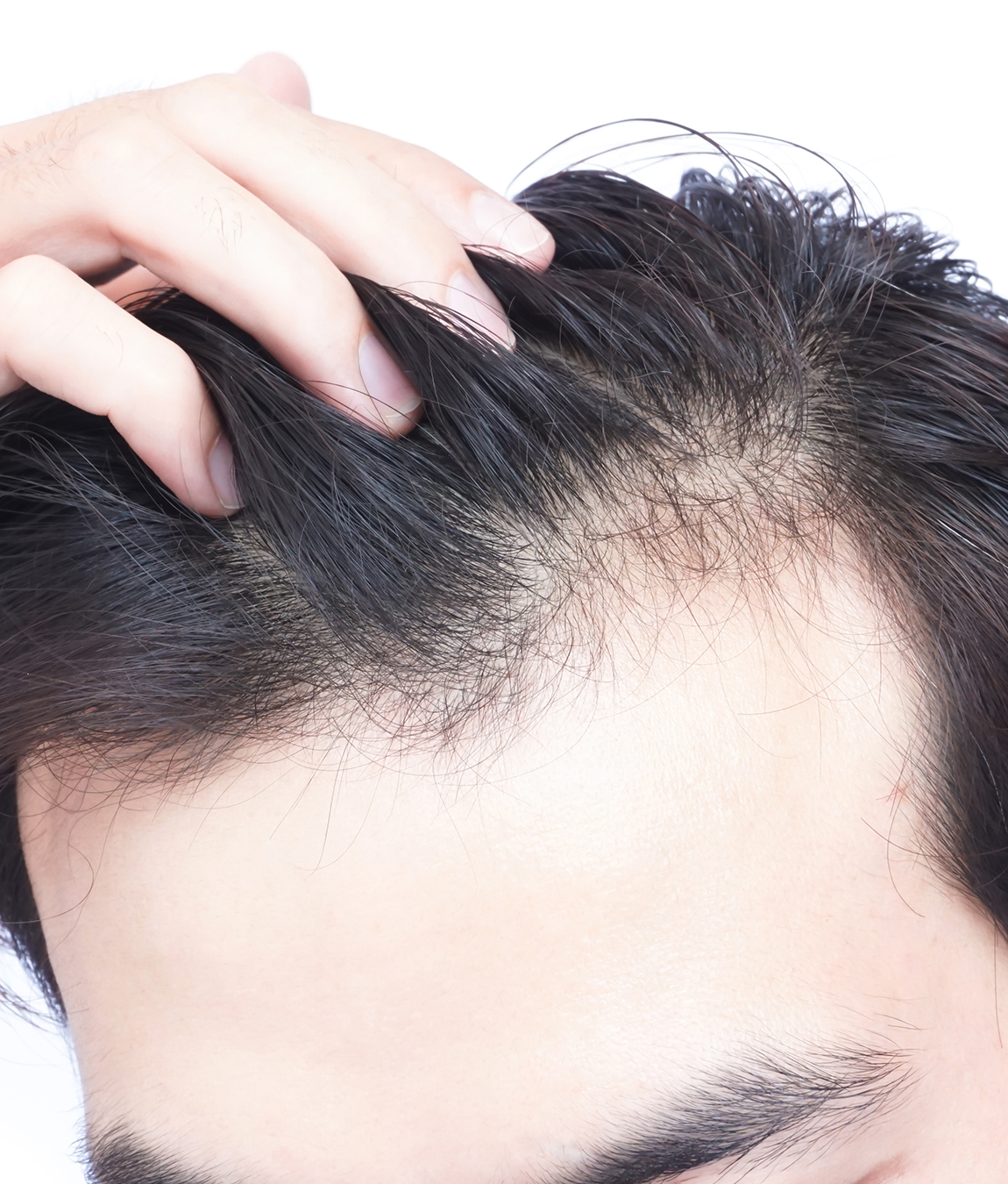 What are the signs of a backward hairline?